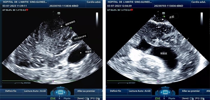 左圖顯示術(shù)中超聲見(jiàn)囊實(shí)性病變，大小約為4x4x3cm，病灶周圍腦組織水腫明顯；右圖為病灶切除后，術(shù)中超聲示術(shù)腔無(wú)病變殘留